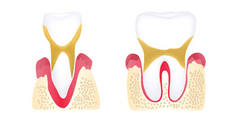 Veneers