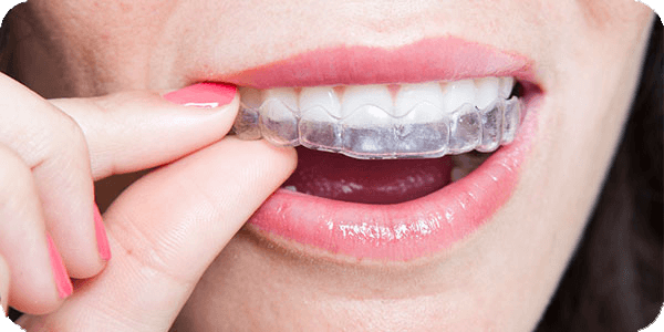 Invisalign Appliance